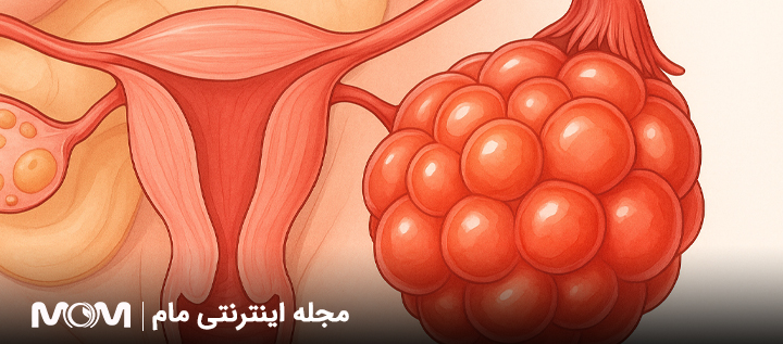 تاثیر هایپراستیمولیشن بر ناباروری